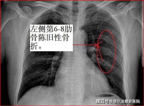 女子被老头乐压到致肋骨骨折 女子被老头乐压到致肋骨骨折